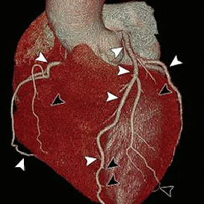 2022 02 15 22 30 4750 2022 02 15 Photon Counting Ct Ccta Figure5 20220215223753
