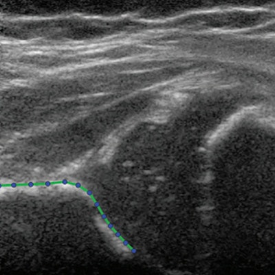Hip ultrasound image in a 3-month-old girl at baseline. No contrast material was used. The presented hip is outlined with the acetabular shape model, consisting of 13 points. The researchers wrote that through statistical shape modeling from ultrasound images, hip dysplasia, and treatment can be better predicted. Image courtesy of RSNA.