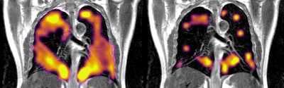 In the image on the right, the dark areas on a COVID-19 patient's xenon MRI scan may represent lung abnormalities. The left image is of a healthy patient.
