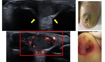 65-year-old woman reported nail dystrophy for several months. Top ultrasound image shows cortical bone rupture (yellow arrows), and Power Doppler identified hypervascularization. The diagnosis was nail melanoma Clark Level 3, where the melanoma cells are touching the next layer down, known as the reticular dermis, or deep dermis. All figures courtesy of Drs. Carolina Avila de Almeida and Clarissa Canella and RSNA.