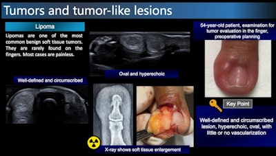 lipoma