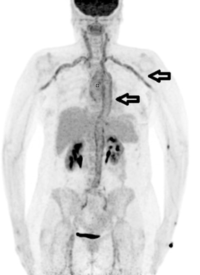A 68-year-old woman who met the FUO criteria. F-18 FDG-PET/CT torso imaging shows longitudinal uptake along the aorta and the large vessels, pathognomonic for giant cell arteritis (arrows). The patient showed only minimal clinical symptoms for vasculitis. Causal anti-inflammatory therapy with oral cortisone was started, to which patient responded well. Image courtesy of Scientific Reports.