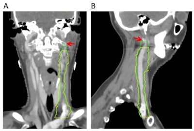 HLII sparing. Coronal (A) and sagittal (B) planning CT images show elective lymph node level contouring of left neck levels II-IVa with (yellow contours) and without (green contours) sparing of HLII. Red arrow: transverse process of C1.