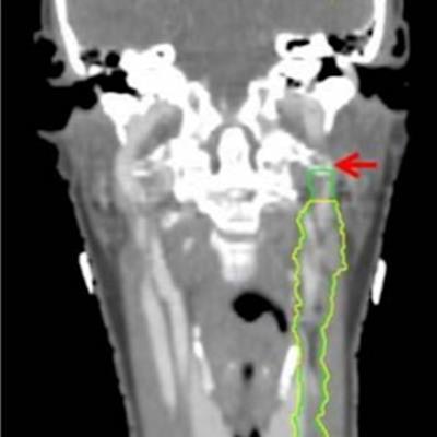 2022 02 09 19 41 9445 2022 02 10 Head And Neck Cancer Figure 2 20220209195426