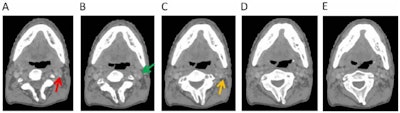 Omission of high level II (HLII) where posterior belly of digastric crosses the posterior aspect of internal jugular vein. Example of axial planning CT slices with intravenous contrast (2 mm slice thickness). A is the most caudal slice; A to E extends superiorly. The level where the posterior belly of digastric muscle crosses posterior aspect of internal jugular vein is shown in C, and it would be the most superior slice of clinical target volume (CTV) delineation, when HLII is omitted from elective CTVs. Red arrow in A: internal jugular vein. Green arrow in B: posterior belly of digastric muscle. Yellow arrow in C: posterior belly of digastric crosses posterior aspect of internal jugular vein. All images courtesy of RCR.