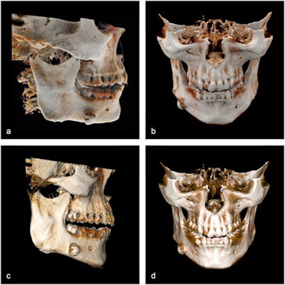 (A, B) Cinematic rendering reconstruction of an exostosis of the right mandibular corpus, oblique-lateral view. (C, D) Volume rendering reconstruction of the same dataset. Images and caption courtesy of Tobias Steffen et al and Annals of Anatomy through Creative Commons Attribution 4.0 International License.