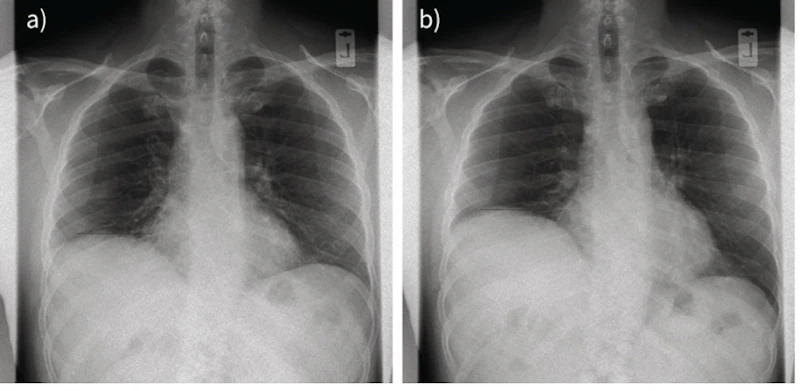 Study: Dynamic chest radiography reveals diaphragm dysfunction ...
