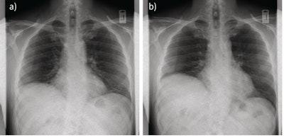 Two still images from a dynamic chest radiography sequence showing paradoxical movement of the paralyzed right hemidiaphragm from (a) rest to (b) end sniff maneuver. Image courtesy of ERJ Open Research.