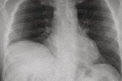 2022 03 01 15 33 1419 2022 02 25 Dcr Diaphragm Dysfunction 20220301154708