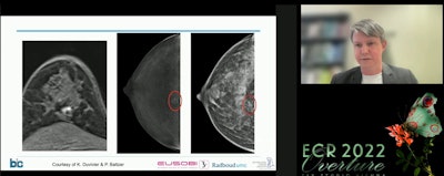Dr. Ritse Mann, PhD, threw his support behind breast MRI in a special 'pros and cons' debate session at the ECR Overture on 2 March. Citing previous research, Mann pointed to MRI's high sensitivity and cost-effectiveness, as well as contrast-enhanced mammography's inherent risks for patients.