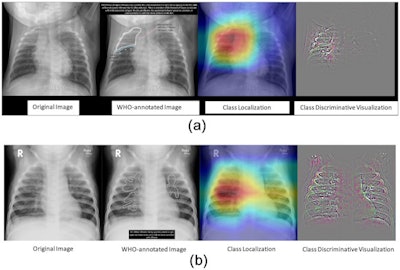 Researchers tested an AI system last year for detecting pneumonia trained on a CheXpert and PERCH dataset of 431 children. The system achieved an AUC of 0.977 for severe pneumonia. Image courtesy of PLOS One.