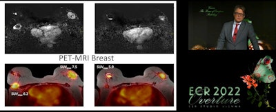 Dr. Thomas Helbich has been a part of recent research looking at hybrid PET/MRI imaging for detecting breast cancer. One recent study he co-authored showed high accuracy in detecting breast cancer by combining mean transit time for dynamic contrast-enhanced MRI and apparent diffusion coefficient maps with radiomics features extracted from PET and coefficient images.
