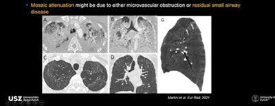 CTs show mosaic attenuation pattern due to microvascular obstruction or residual small airway disease.