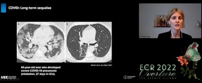 (A) CT shows a 65-year-old patient in subacute stage with bilateral ground-glass opacities and consolidation and in posterior lung area, signs resembling COP. (B) After six months, consolidation has mainly resolved but some ground-glass opacities remain in posterior right zone of lung and within this, an area of bronchial distortion.