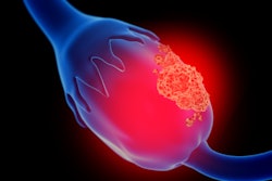 2022 03 09 16 12 7153 Ovarian Cancer2 400