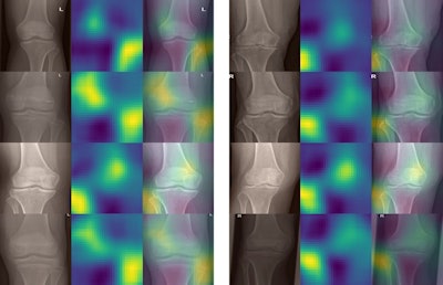 Occlusion sensitivity maps for randomly selected images from the internal validation cohort (left column) and external validation cohort (right column). In each row, first the cropped, original image is shown, then the occlusion sensitivity map, and finally an overlay of both. In general, two hot spots are visible, which correspond to the region that is most important for the network for its decision: the fibula as well as the lower end of the femur opposite to the fibula. Image courtesy of Scientific Reports.