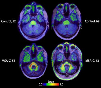 PET images using the radiotracer ACI-12589 (Selegiline, AC Immune) showing visual uptake in areas of interest associated with multiple system atrophy (MSA). Image courtesy of AC Immune.