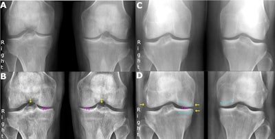 Examples of false-negative and false-positive findings by RBknee. Yellow arrows indicate osteophytes, solid purple vertical lines indicate joint space narrowing, and striped curved turquoise lines indicate subchondral sclerosis. The left column shows an 81-year-old man with prednisolone-treated polymyalgia rheumatica, referred for posterior-anterior, weight-bearing radiograph of both knees under indication of knee pain with unspecified laterality. (A) shows the original radiograph. (B) shows the same radiograph annotated by the AI tool. The radiology consultant consensus graded the right knee as Kellgren-Lawrence grade 2 while the artificial intelligence tool graded it as 0. They both graded the left knee as 2. Note that this is the only case where the artificial intelligence tool graded a knee 2 or more points lower than the consensus. The right column shows a 46-year-old woman referred for posterior-anterior, weight-bearing radiograph of both knees under indication of knee pain with unspecified laterality. (C) shows the original radiograph. (D) shows the same radiograph annotated by the artificial intelligence tool. The radiology consultant consensus graded the right knee as Kellgren-Lawrence 1 while the artificial intelligence tool graded it as 2. Notably, all readers except one consultant and one resident radiologist graded the knee as 2 or higher. Figure courtesy of the European Journal of Radiology.