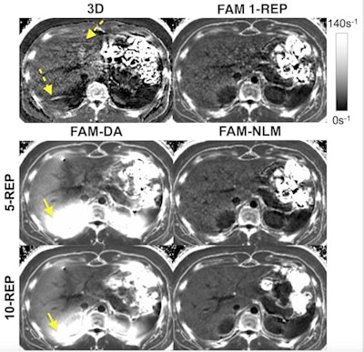 The free-breathing multi-repetition 2D chemical shift-encoded (CSE) flip angle modulation (FAM) nonlocal means (NLM) R2* maps showed significant improvement in signal-to-noise ratio (SNR) and reduction of artifacts. Shown here are R2* maps of an 18-year-old male patient with an R2* of 41 s-1. Motion artifacts are depicted by dashed arrows. Of note are signal inhomogeneities (arrows) in the right lobe with multi-repetition FAM using direct averaging (DA), which lead to bias. Note the improved image quality and higher SNR with increasing number of FAM repetitions (REP = number of repetitions). Representative scores for SNR, artifacts, and overall image quality are 3,2,2 (3D); 3,5,4 (FAM 1- REP); 5,2,2 (FAM-DA 5-REP); 4,5,4 (FAM-NLM 5-REP); 5,2,3 (FAM-DA 10-REP); and 5,5,5 (FAM-NLM 10-REP). Image courtesy of Dr. Jitka Starekova, Ruiyang Zhao et al.; University of Wisconsin; and European Radiology.