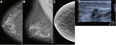 Artificial intelligence (AI) gave a score of 10 to this screen-detected ductal carcinoma in situ (DCIS) in a 68-year-old woman, indicating high risk for breast cancer. (A) Mammogram of right breast from the craniocaudal view. (B) Mammogram of right breast from the mediolateral oblique view. (C) Craniocaudal digital breast tomosynthesis (DBT) image of the right breast. (D) Ultrasound image of the right breast. The arrows in images A and C indicate the malignancy, with the dotted line in image D showing tumor diameter. Image courtesy of Radiology.