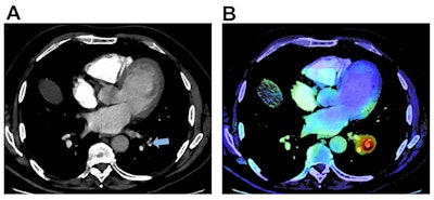 Example of an output provided by the AI algorithm (AIDOC Medical) to detect pulmonary embolism (PE). A: 64-year-old man presented with spontaneous unilateral pain in the lower limb, increased with palpation, and unilateral edema. The revised simplified Geneva score was 3 and the D-dimer dosage was positive. A contrast-enhanced CT pulmonary angiogram (CTPA) demonstrated a PE in the left lower limb (blue arrow). B: On the same cross-section, the AI algorithm highlighted the same location of the suspected PE through a color-encoded map. All figures courtesy of Dr. Alexandre Ben Cheikh and colleagues and European Radiology.