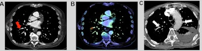 Clinical examples. A 71-year-old patient with a medical history of cancer and recent surgery presented with heart rate > 95 beats per minute and a borderline saturation and underwent a CTPA. The CTPA showed a segmental, sub-acute, PE in the right low limb, which was missed by the emergency radiologist during his on-call duty (red arrow). B: On the same cross-section, the PE was correctly identified by the AI algorithm (AIDOC Medical). Example of PE was correctly diagnosed by the emergency radiologist and not by the AI algorithm. Opposite example: An 85-year-old patient with a medical history of PE and a recent surgery presented with a heart rate between 75 and 94 beats per minute and acute dyspnea and underwent CTPA (C). Two segmental PEs were correctly diagnosed by the emergency radiologist but missed by the AI algorithm (white arrows).