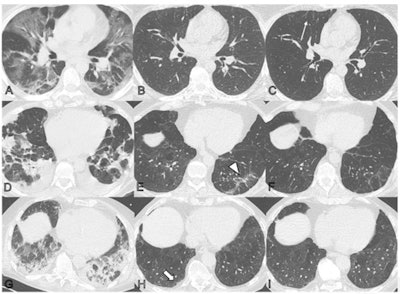 Serial noncontrast axial chest CT exams of three study participants with prior COVID-19 pneumonia. Chest CT of a 44-year-old man (upper row, A-C) displayed extensive bilateral ground-glass opacities (GGO) and supleural reticulation during acute COVID-19 (A). At the two-month follow-up almost complete resolution of GGO with residual subpleural reticulation in the middle lobe was noted (B). These subpleural reticulations (arrow) persisted up to one year after onset (C). Chest CT of a 68-year-old-man (middle row, D-F) demonstrated patchy bilateral consolidations, a subpleural arcade-like sign, and pleural effusions during active infection (D). At the two-month follow-up, a substantial improvement of organizing pneumonia pattern was noted with GGO and subpleural reticulation including arcade-like sign (arrowhead) in the left lower lobe (E). At the one-year follow-up, further improvement was noticed. However, subtle reticulation and GGO could still be detected (F). Chest CT of a 79-year-old man (lower row, G-I) displayed bilateral consolidations and small areas of GGO while admitted to the intensive care unit (G). At the two-month follow-up, residual GGO and small subpleural microcystic changes (thick arrow) were noticed (H), which persisted up to one year after onset (I). Images and caption courtesy of the RSNA.