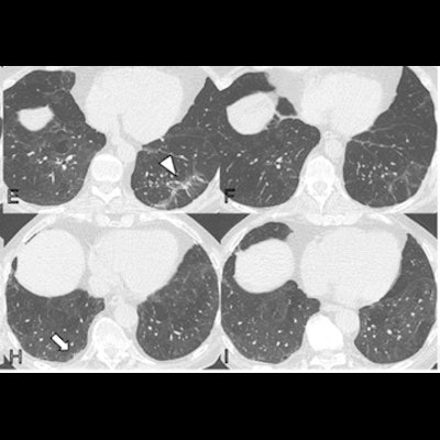 2022 04 01 15 02 5402 2022 04 04 Lung Ct Covid Figure4 400