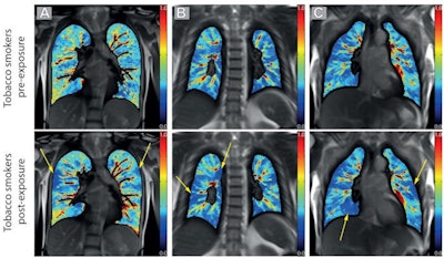 (A-C) Example of pulmonary perfusion images obtained by using noncontrast-enhanced matrix pencil MRI in three different tobacco smokers before exposure (preexposure) and after exposure (postexposure). The images before and after exposure were acquired at corresponding coronal section locations. Arrows indicate lung regions with decreased regional perfusion after the exposure to nicotine. Red corresponds to high values of ventilation amplitude and perfusion amplitude, whereas blue corresponds to low values. Images and caption courtesy of the RSNA.