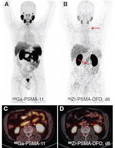 Ga-68 PSMA-11 PET with maximum-intensity-projection (MIP) (A) and PET/low-dose CT fusion images (C), and Zr-89 PSMA-DFO PET six days after injection with MIP (B) and PET/low-dose CT fusion images (D) of a patient with biochemical recurrence after prostatectomy and stereotactic radiation therapy. Images are highly suggestive of PSMA-positive lymph node metastases supraclavicular left and retroperitoneal left, visible with Zr-89 PSMA-DFO (red arrows in B and D). Lymph nodes were PSMA-negative with Ga-68 PSMA-11 (yellow arrow in C). Patient underwent SRT and temporary ADT and PSA level dropped to 0.17 ng/mL. Image courtesy of Journal of Nuclear Medicine.