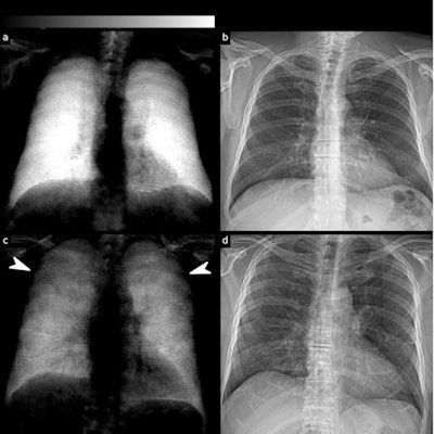 (a) Dark-field and (b) conventional (attenuation-based) chest radiographs of a healthy subject. The dark-field radiograph exhibits a strong, homogeneous dark-field signal. The respective attenuation-based image shows no apparent pathology. (c) Dark-field and (d) attenuation-based chest radiographs of a patient infected with COVID-19. Compared with the healthy subject, the infected patient shows an overall decrease of signal intensity. While the signal of the healthy subject is homogeneous, the dark-field signal of the infected patient appears inhomogeneous and patchy, especially in the periphery of the lung (arrowheads). Image courtesy of Research Square.