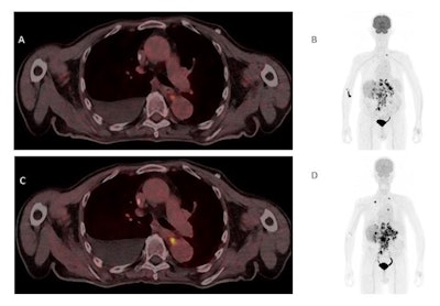 (A) Single-tracer PET/CT with F-18 FDG showing fused images in the axial plane of a primary tumor at the gastroesophageal junction with a metastasis in the left adrenal gland and liver metastases. (B) Maximum intensity projection (MIP) of single-tracer PET images displaying high uptake in brain tissue, tracer accumulation around the injection side at the right elbow, lymph node metastasis in the left upper mediastinum, multiple abdominal lymph node metastases, and liver metastases. An additional benign accumulation of FDG is visible, caused by right-sided thoracolumbar osteoarthritis. (C) Transverse section of fused dual-tracer F-18 FDG and Ga-68 FAPI-46 PET/CT of the same patient. (D) As all images were visually normalized to the uptake of the liver, MIP of dual-tracer PET/CT in the same patient shows a less pronounced tracer accumulation in the brain tissue, compared to single-tracer PET/CT. In addition to lesions detected with single-tracer PET/CT, further abdominal lymph node metastasis and liver metastases are visualized via dual-tracer PET/CT. The focal tracer accumulation in the right vein angle is due to intravenous tracer accumulation from the former tracer depot at the right elbow. Image courtesy of the Journal of Nuclear Medicine.