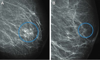 (Left) A full-field digital mammogram of a 61-year-old woman shows a diagnosed interval cancer that was automatically recalled by the AI system. The system categorized the mammogram as suspicious with an examination score of 9.99. The circle shows the area marked by the AI that surrounds suspicious microcalcifications. The woman was not recalled by the radiologists at screening. (Right) A mammogram of a 56-year-old woman shows a diagnosed screen-detected cancer found by radiologists. The circle surrounds the cancer, presenting as a spiculated mass. The AI system marked no suspicious areas in the mammogram and gave it a low examination score of 3.73, categorizing it as normal. Image courtesy of the RSNA.