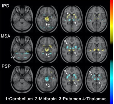 Visualization of average saliency maps of patients with idiopathic Parkinson's disease (IPD), multiple system atrophy (MSA), and progressive supranuclear palsy (PSP) in the training cohort showing characteristic regions contributing to the deep metabolic imaging (DMI) indices. The color corresponds to the importance score indicating the contribution of a region for the generated DMI indices. The color directions (yellow and red vs. cyan and blue) represent different influences on the DMI indices (increased uptake value contributes to the increase or decrease of the probability of IPD, MSA, or PSP in the DMI indices). The arrows pointed to the most salient brain regions including 1: Cerebellum, 2: Midbrain, 3: Putamen, and 4: Thalamus. Image courtesy of the Journal of Nuclear Medicine.
