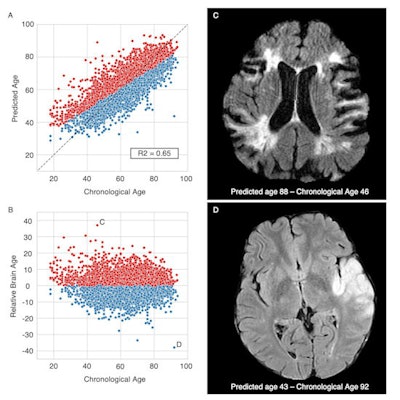 Brain age prediction performances and relative brain age. Scatter plots of the T2-FLAIR radiomics (A) predicted brain age and (B) relative brain age (RBA) per chronological age. Patients were colored in red if they had a positive RBA, so a brain that appeared 'older' to their age-matched peers, or in blue if they had a negative RBA and a 'younger' looking brain. (C) T2-FLAIR axial image of a patient with a positive RBA: predicted brain age = 88, chronological age = 46, RBA = 36.2; this patient's brain exhibits multiple cortical and subcortical sequelae, moderate to severe parenchymal atrophy with enlarged ventricles and sulci, and confluent white matter hyperintensities, the extents of which are unexpectedly large for a 46-year-old patient. (D) T2-FLAIR axial image of a patient with a negative RBA: predicted brain age = 43, chronological age = 92, RBA = -38.6; notwithstanding the left middle cerebral artery lesion, this patient's brain trophicity is maintained, the cortex and the deep gray nuclei are sharply defined, overall describing a healthy brain for this 92-year-old patient. Courtesy of Dr. Martin Bretzner and ESOC 2022.