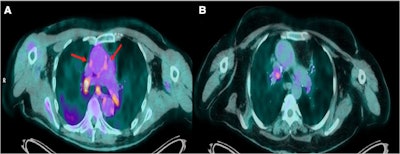 Transaxial views of fused F-18 FDG PET/CT images of two patients with COVID-19. (A) A patient scanned 20 days after admission with severe COVID-19. (B) A patient scanned 64 days after admission. In the former, there is increased F-18 FDG uptake in the wall of the ascending aorta (arrows), as well as hypermetabolic hilar and mediastinal lymph nodes. Image courtesy of the Journal of Nuclear Cardiology.