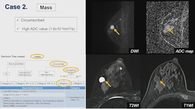 Noncontrast sequences from MRI, such as T1- and T2-weighted imaging, could further help diffusion-weighted breast imaging, according to research presented May 9 at ISMRM 2022.