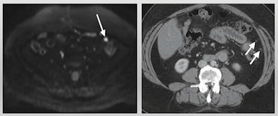 MRI has advantages over CT for ovarian cancer screening and disease response prediction, according to a presentation by Dr. Anju Sahdev at the International Society for Magnetic Resonance in Medicine annual meeting. In this example of low-volume disease, diffusion-weighted imaging MR (left) detects nodules more clearly than CT (right). Image courtesy of Dr. Anju Sahdev.