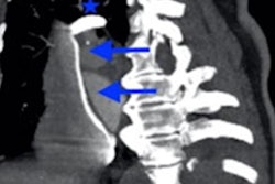 2022 05 12 15 53 4175 2022 05 13 Contrast Pooling Ct Cardiac Arrest Figure1 20220512153020