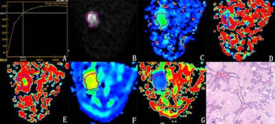 Diffusion-weighted MR imaging models can differentiate between malignant and benign breast lesions, according to research presented at the ISMRM annual meeting. Here, a 56-year-old woman presents on DWI with a mass in the outer-inner quadrant of the left breast. The pathological diagnosis of this mass was phyllodes fibroadenoma. Image courtesy of Dr. Wang Hongjie.