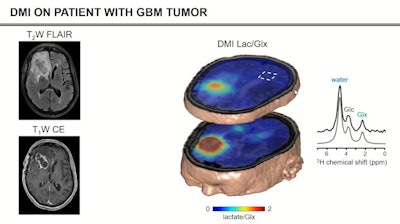 Deuterium metabolic imaging has made a reemergence in the research realm as an imaging modality that can be used with MRI. Researchers at the ISMRM meeting said it can be used as a safe, effective contrast agent to image parts of the body for tumor detection, such as the brain (pictured). Image courtesy of Robin de Graaf, PhD.