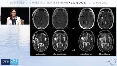 2022 05 17 23 36 1612 2022 05 18 Ismrm Marion Smits Presentation