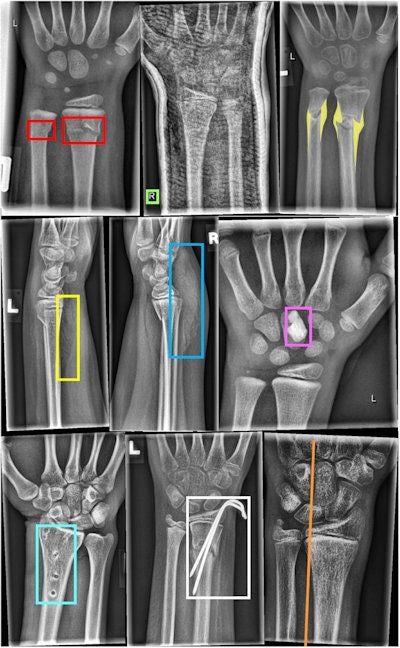 Examples of different objects labeled by human experts. In the first row, from left to right: Fracture (bounding box), text (bounding box), periosteal reaction (polygon). In the second row, from left to right: Pronator quadratus sign (bounding box), soft-tissue swelling (bounding box), foreign body (bounding box). In the last row, from left to right: Bone anomaly (bounding box), metal (bounding box), and axis (line). The middle radiograph in the first row shows a cast. The right images in the first and third row were tagged with osteopenia. Image courtesy of Scientific Data.