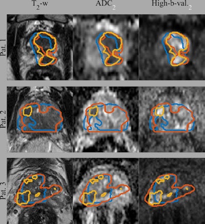 Gross tumor volume (GTV) segmentations overlaid on the input image sequences for three patients from the test set. Ground truth segmentations GTV-Histo (blue), GTV-MRI (orange), and the predicted segmentation GTV-CNN (yellow). Courtesy of Deepa Darshini Gunashekar, Prof. Dr. Michael Bock, and Radiat Oncol 2022 (2 April);17(1):65.