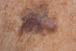 2022 05 24 21 23 1515 Skin Cancer 400
