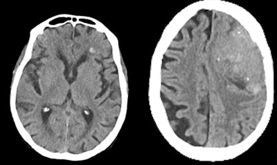 (Left) True-positive brain hemorrhage in a patient with head trauma. (Right) False-positive hemorrhage in a patient with a left frontal calcified meningioma. Images courtesy of Prof. Dr. Laura Oleaga.