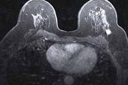 2020 02 25 00 56 9513 Mri Breast Cancer 20200225003131