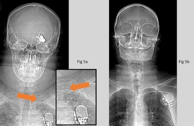 (Left) CT scout image of patient with vagal nerve stimulator (VNS). (Right) patient with pacemaker. Both active implants were recognized as such, but the VNS was incorrectly identified as a pacemaker. The VNS (5a) can be distinguished from a pacemaker (5b) by the metallic attachments to the vagus nerve (orange arrow). Any active implant poses a high risk in MRI and would need to be investigated thoroughly before proceeding. All images courtesy of Hannah Barnsley, Sam Chigozie Uzoukwu, Marco Borri, PhD, and the ISMRM.