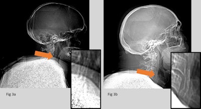 (Left) CT scout image contains the missed carotid stent. (Right) Carotid stent correctly identified. The carotid stent in Fig. 3a, although visible, is partially obscured by superimposed anatomy. This case shows implants can be difficult to identify, and both image quality and the experience of staff can play a role.