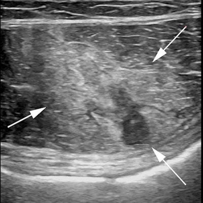 Professional tennis player who experienced acute onset abdominal wall pain while serving during a match. Transverse ultrasound image of the left rectus abdominus muscle demonstrates an acute muscle injury with edema, acute hemorrhage, and a small focal hyperacute hematoma.